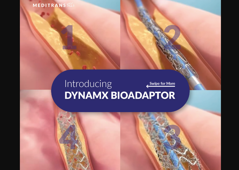 Inovasi Pengobatan Penyakit Arteri Koroner dengan Elixir DynamX Bioadaptor