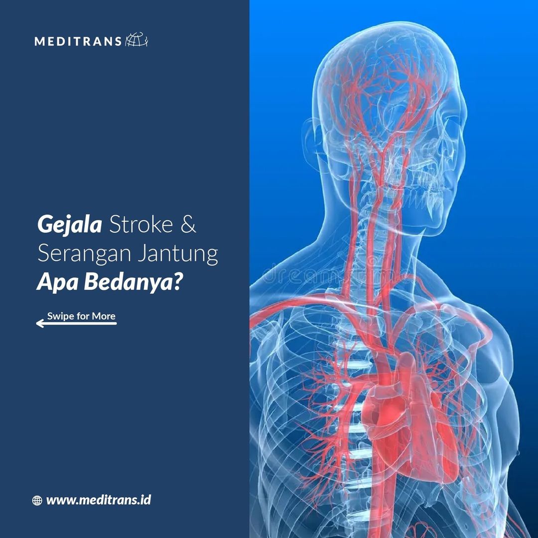 Perbedaan Gejala Stroke Dan Serangan Jantung: Mengenal Tanda Bahaya ...