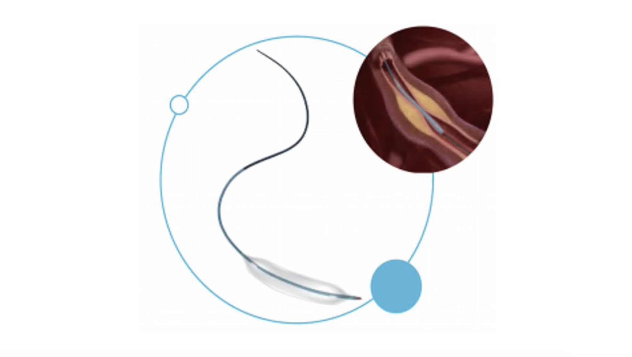 Gusta II PTCA Balloon Dilatation Catheter - Meditrans Global