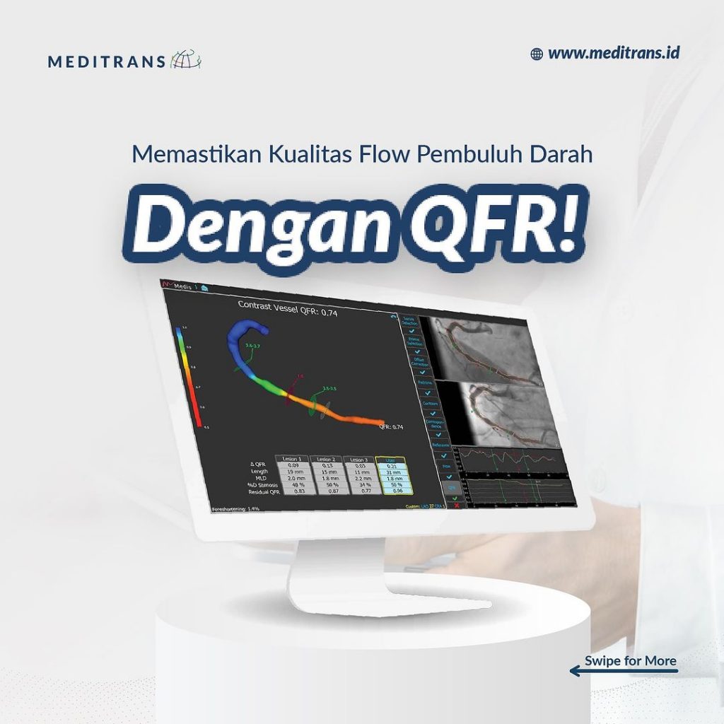 Memastikan Kualitas Flow Pembuluh Darah dengan Quantitative Flow Ratio (QFR)